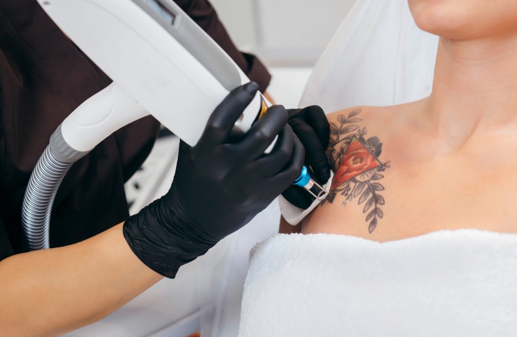 Tattoo Removal