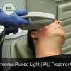 IPL Photofacial - Image 4