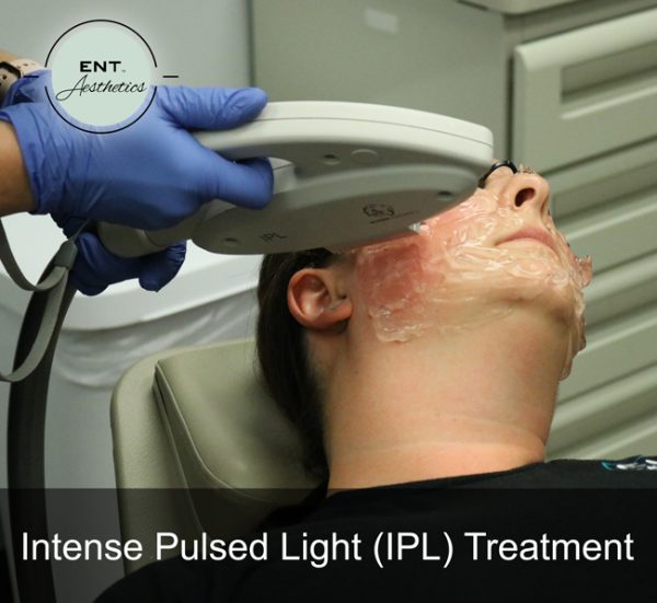 IPL Photofacial - Image 4