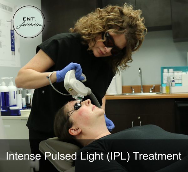 IPL Photofacial - Image 3