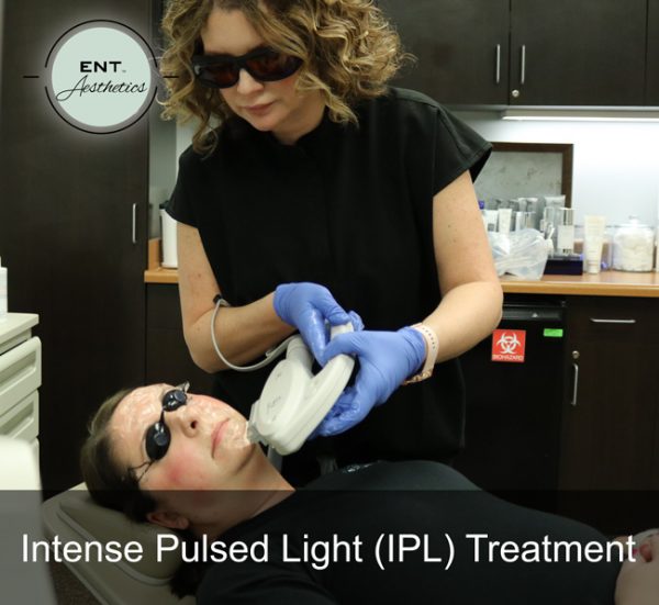 IPL Photofacial - Image 2