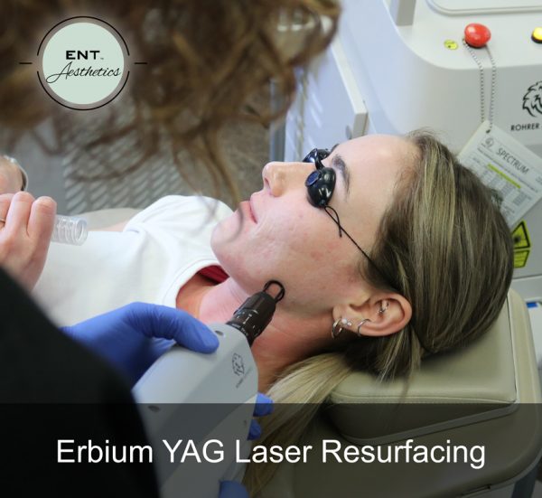 Erbium YAG Laser Resurfacing - Image 4