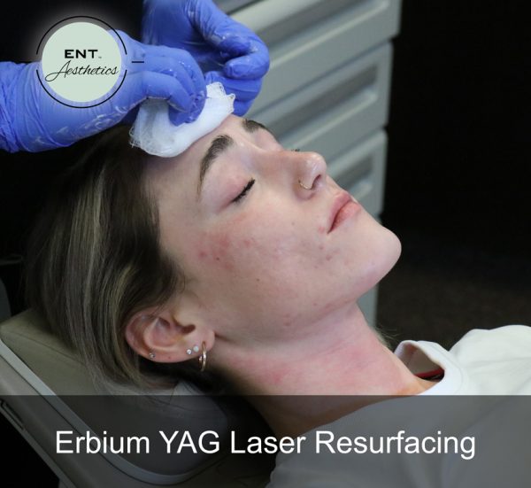 Erbium YAG Laser Resurfacing - Image 3