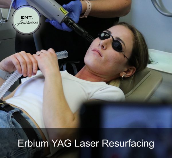 Erbium YAG Laser Resurfacing - Image 2