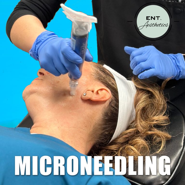 Microneedling