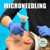 Microneedling