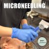 Microneedling - Image 4