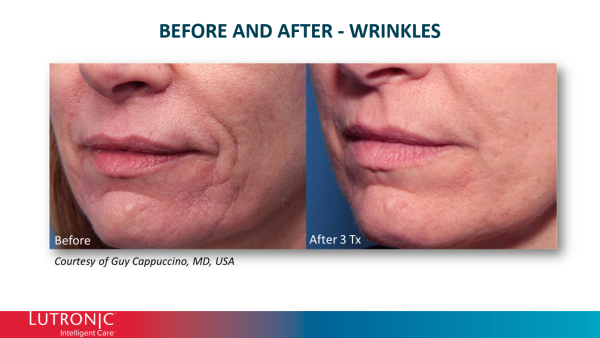 Genius RF Microneedling - Image 4