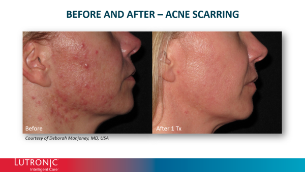 Genius RF Microneedling - Image 5