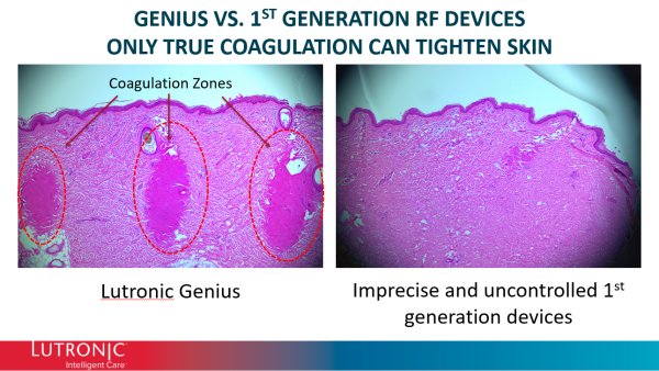 Genius RF Microneedling - Image 2