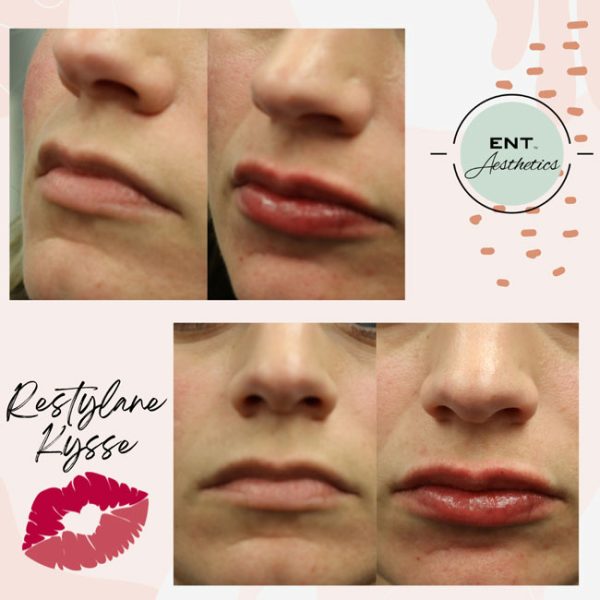 Restylane Fillers - Image 2